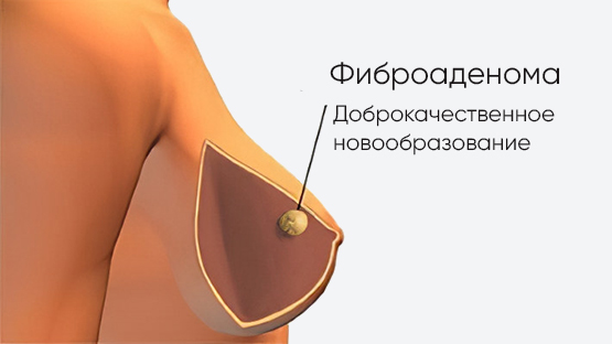 Лазерное лечение фиброаденомы молочной железы в Барнауле